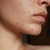 acne-harmony-medical-cosmetic-dermatology-medical-aesthetics-67179dd15df60 (1)