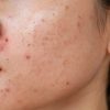 cropped-shot-of-woman-having-problems-of-acne-inflamed-on-her-face-1288757698-3935x2429-scaled-e1690312168244-1024x677-67179dd32e392