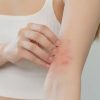 eczema-harmony-medical-cosmetic-dermatology-medical-aesthetics-67179dc74d45a